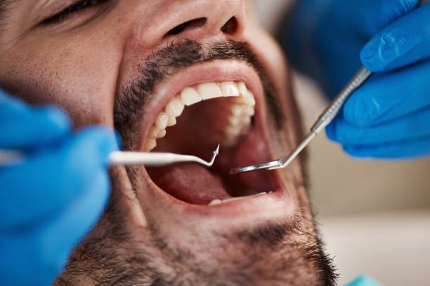 Best Broken or Chipped Tooth Repair in Vevay, IN