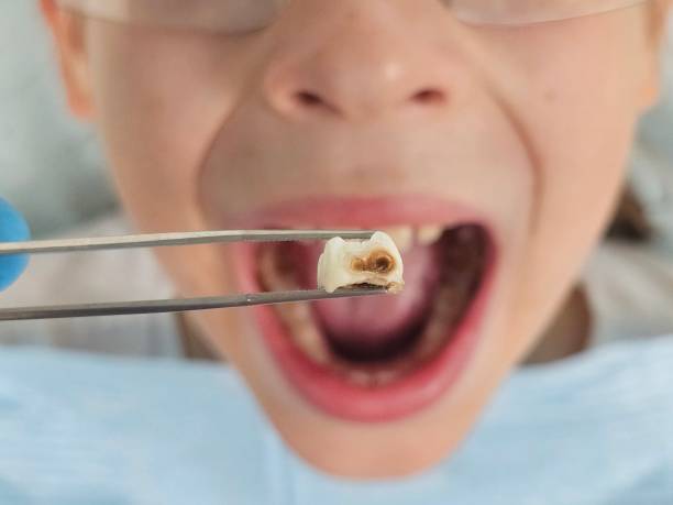 Best Emergency Dental Care for Sports Injuries in Vevay, IN